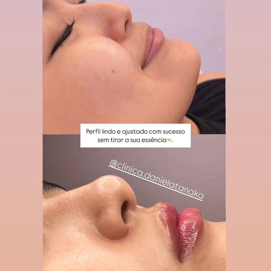 Harmonização de perfil, antes e depois