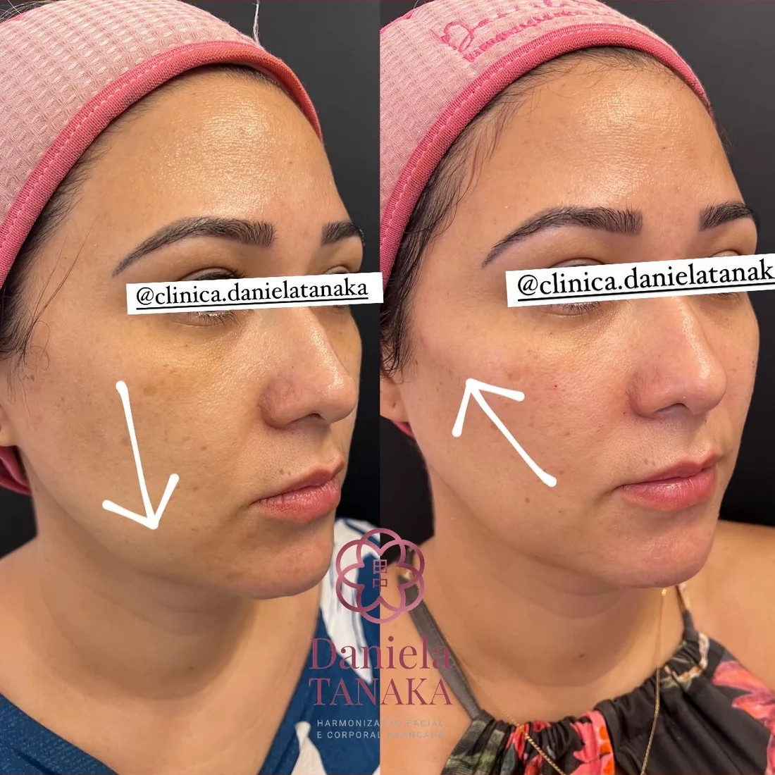 Pixie Plus Full Face com Radiesse, antes e depois