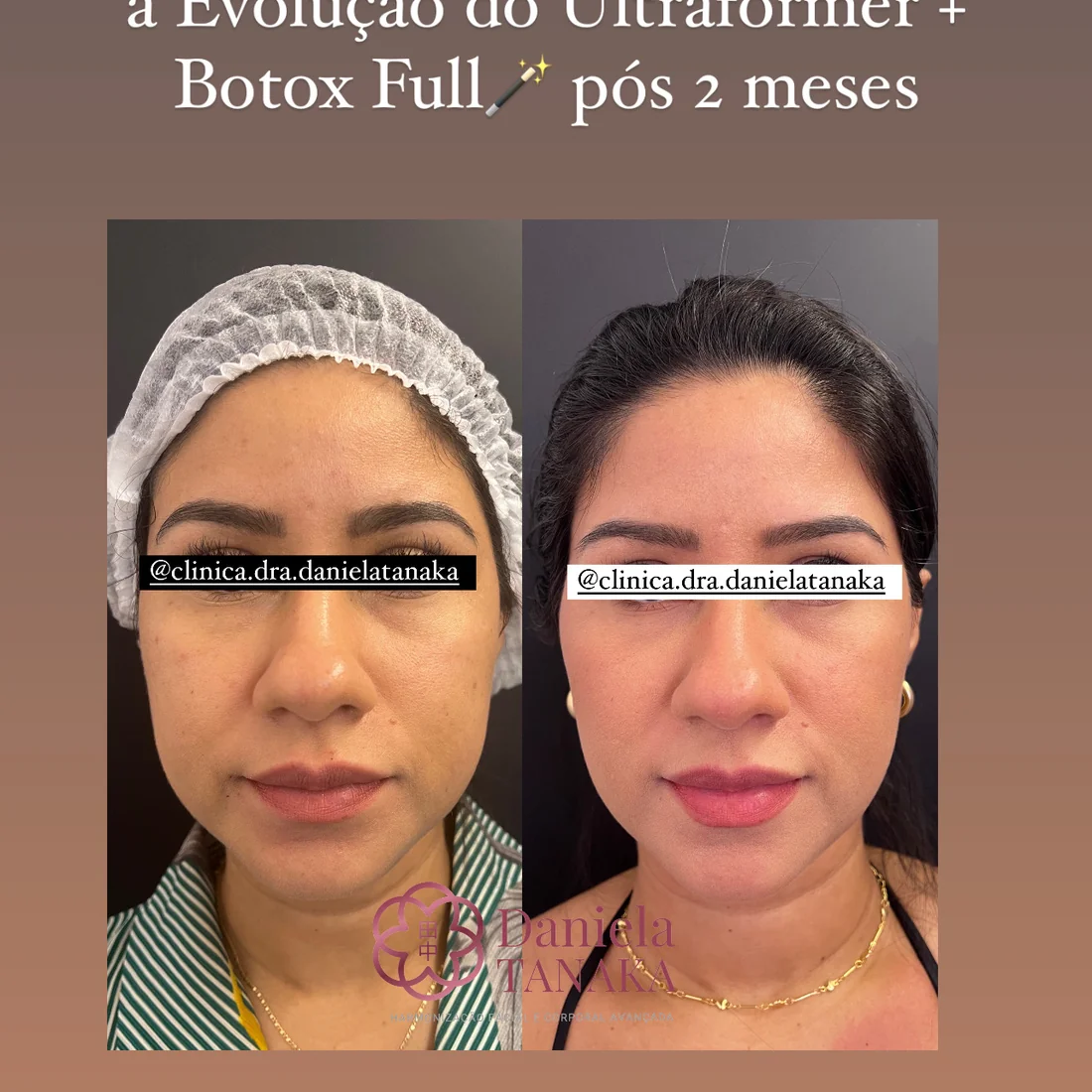 Pixie Plus, Ultraformer e Botox Full, antes e depois pós 2 meses